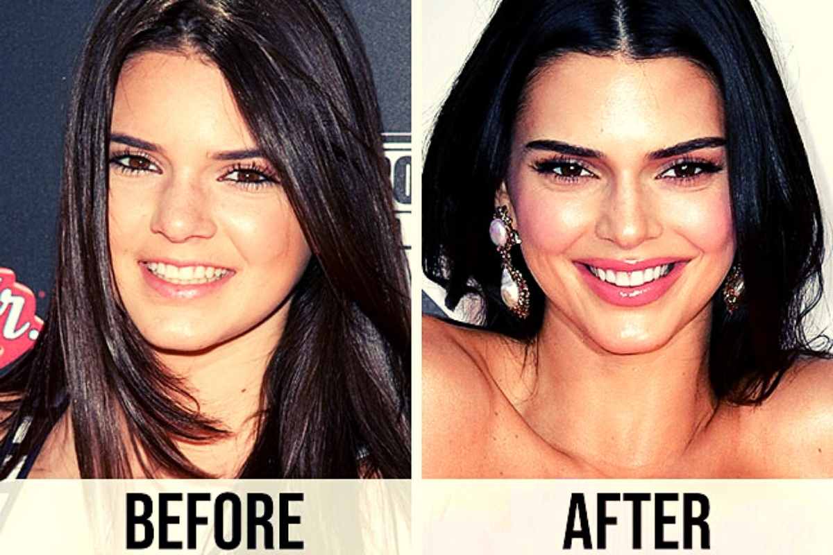 Kendall Jenner's Plastic Surgery 