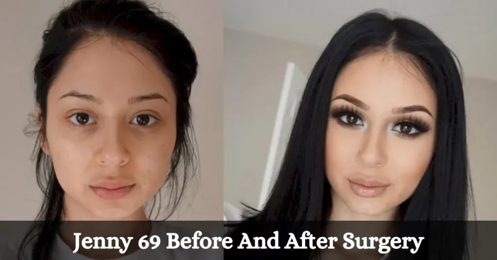 Jenny 69 Before And After Surgery