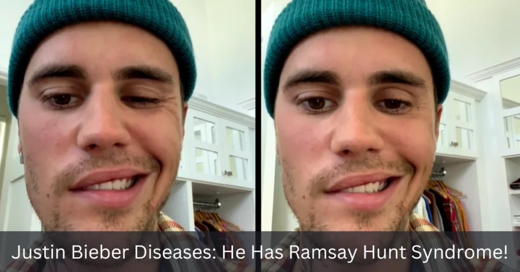 Justin Bieber Diseases He Has Ramsay Hunt Syndrome