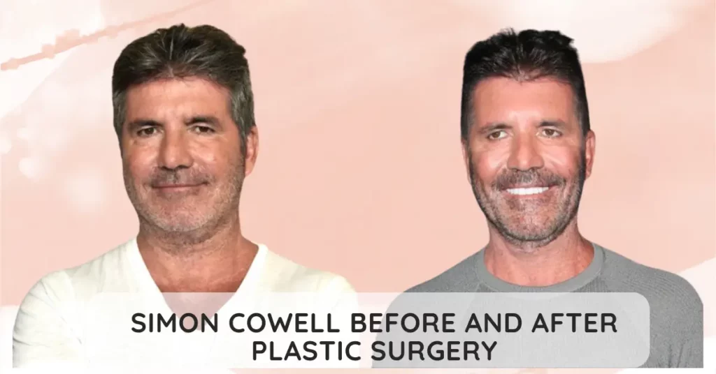 Simon Cowell Before And After Plastic Surgery
