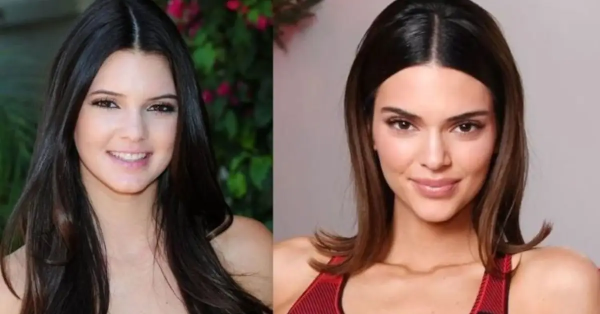 Kendall Jenner Before Surgery-