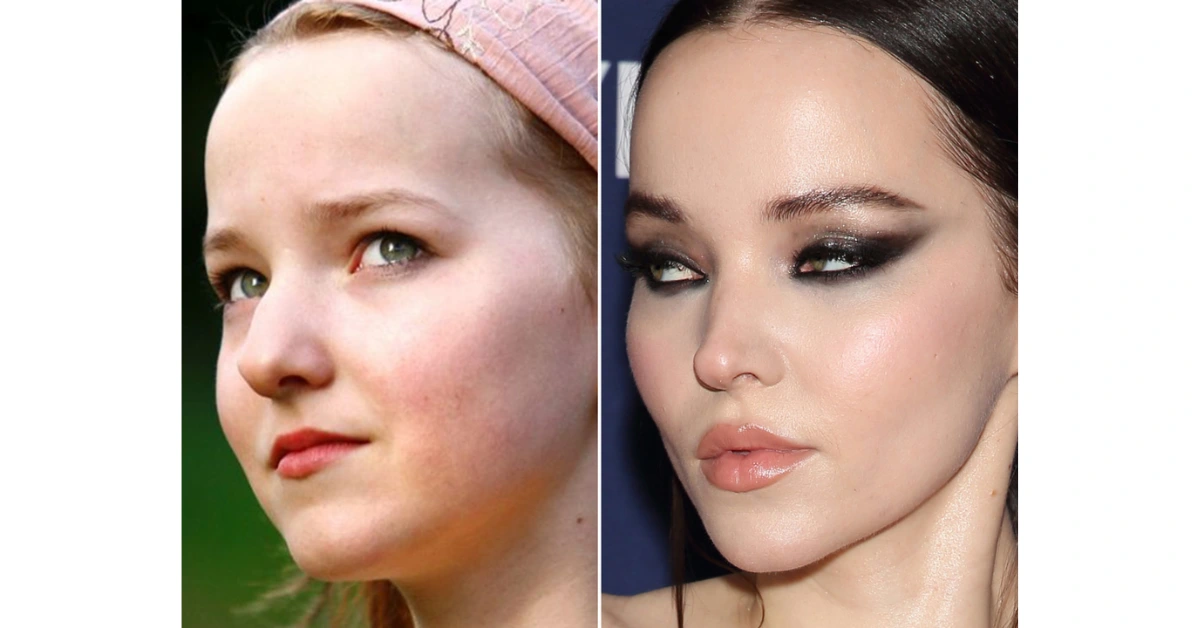 Did Dove Cameron Get Plastic Surgery? Before And After Look