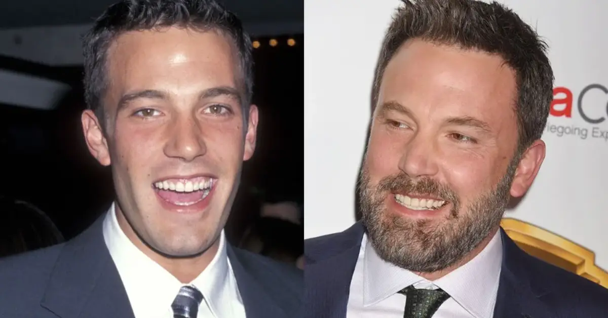 Ben Affleck Teeth Before And After