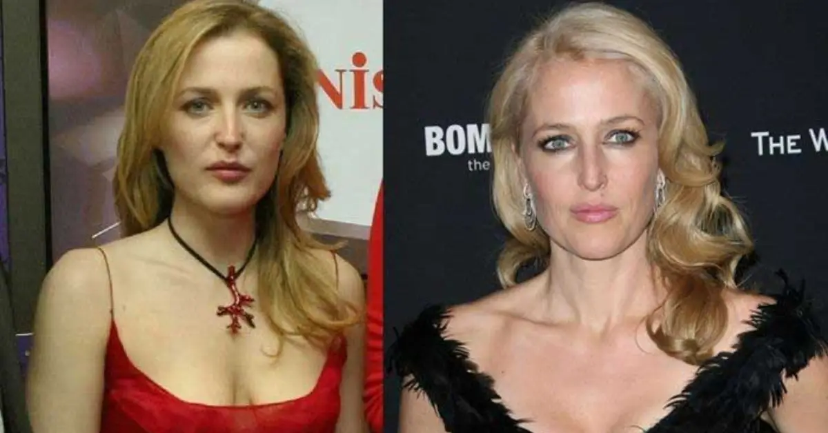 Gillian Anderson Plastic Surgery