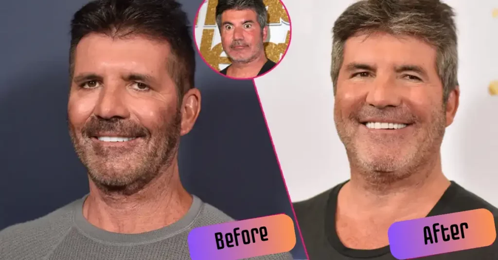 Simon Cowell Before And After